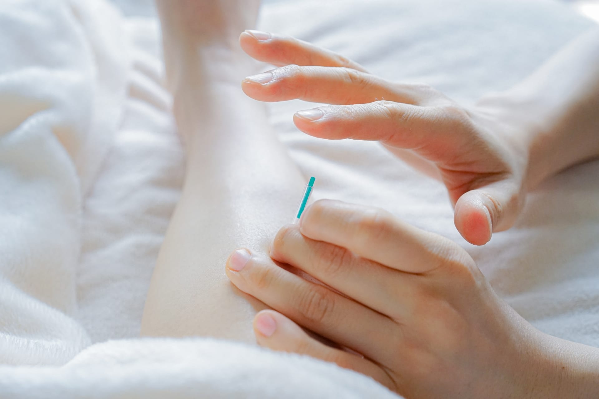 鍼治療の写真 不妊治療